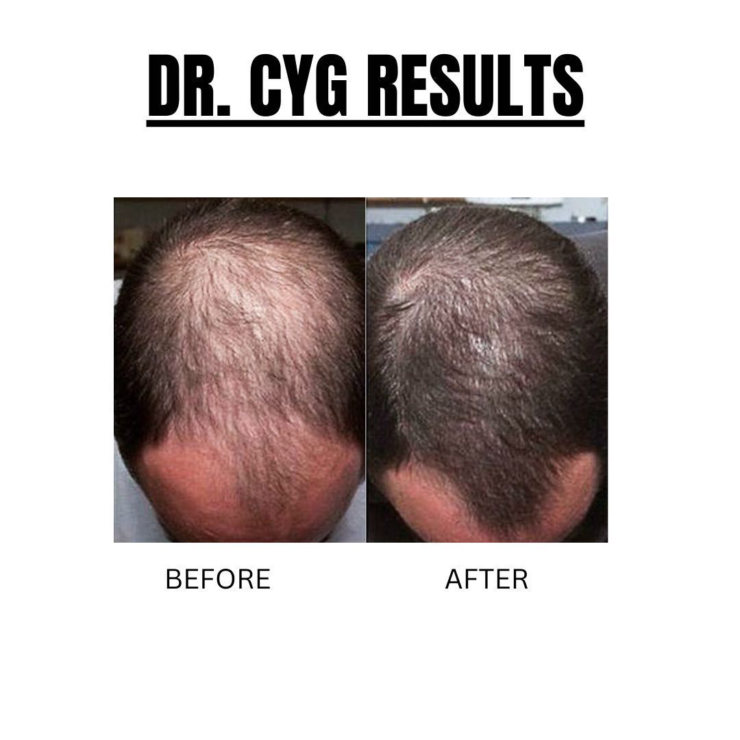DR. CYJ Hair Filler per session portfolio