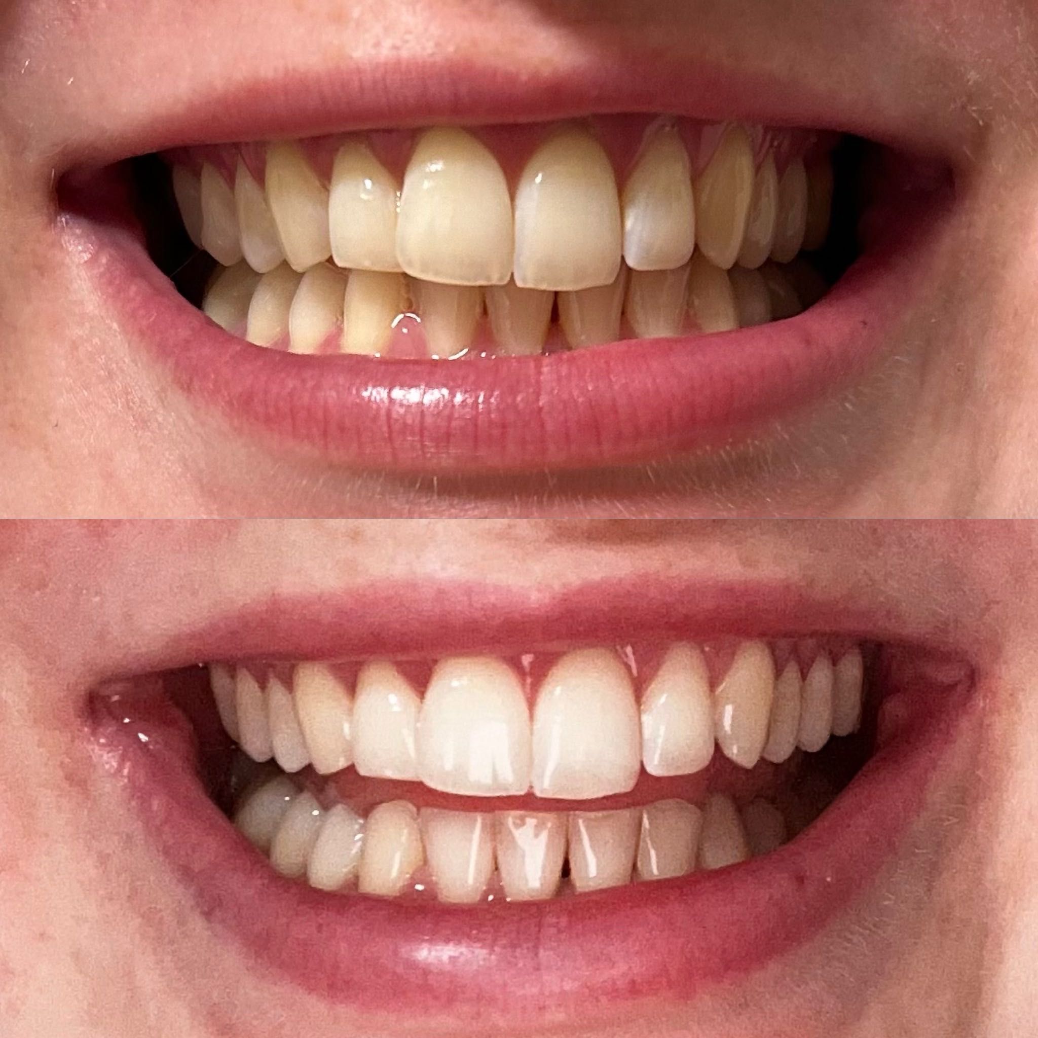 Naturawhite laser teeth whitening portfolio