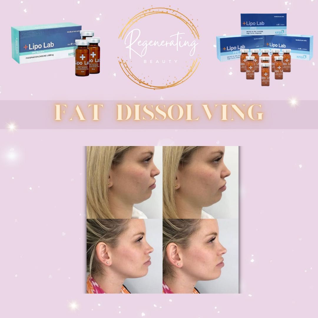 Fat Dissolving injection - Chin/Jaw portfolio