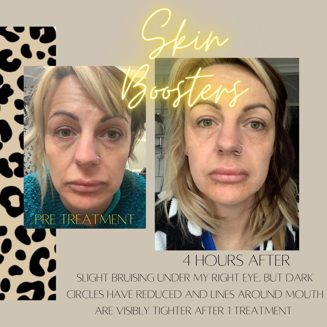 Skin Boosters / Mesotherapy 1 session £30 off portfolio