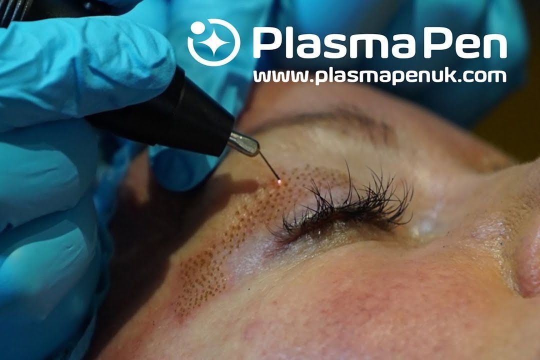 Plasma Pen Skin Resurfacing (Spraying) portfolio