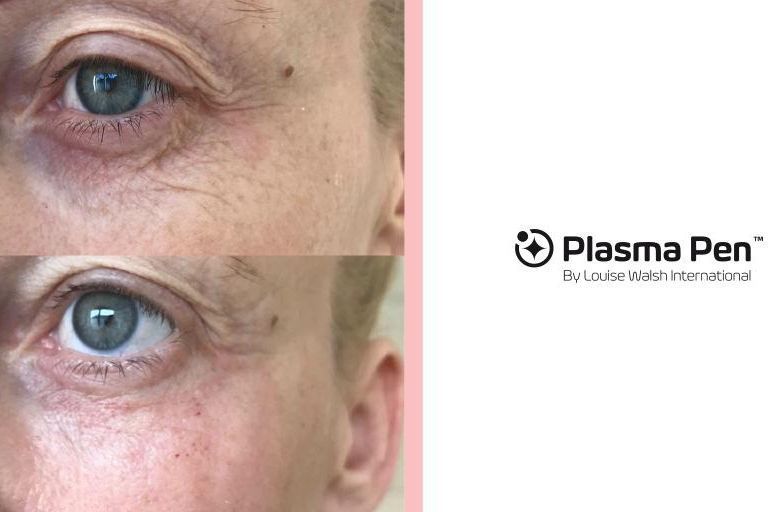 Plasma Pen Blephoraplasty (upper eye lids) portfolio