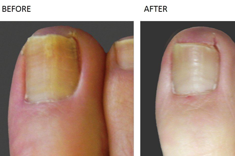 IPL Nail Fungus treatment (10 toes) portfolio
