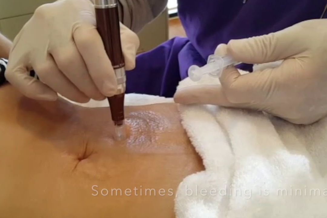 PRP Microneedling for Stretch Marks or Scars portfolio