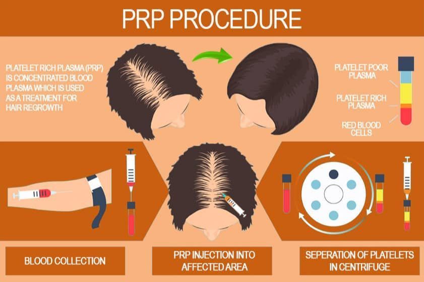 PRP Hair Loss Treatment portfolio
