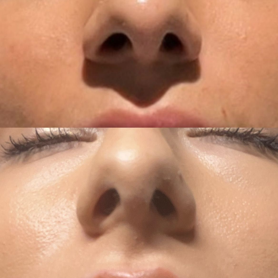 Nasal Flare Botox (Nose Slimming) portfolio