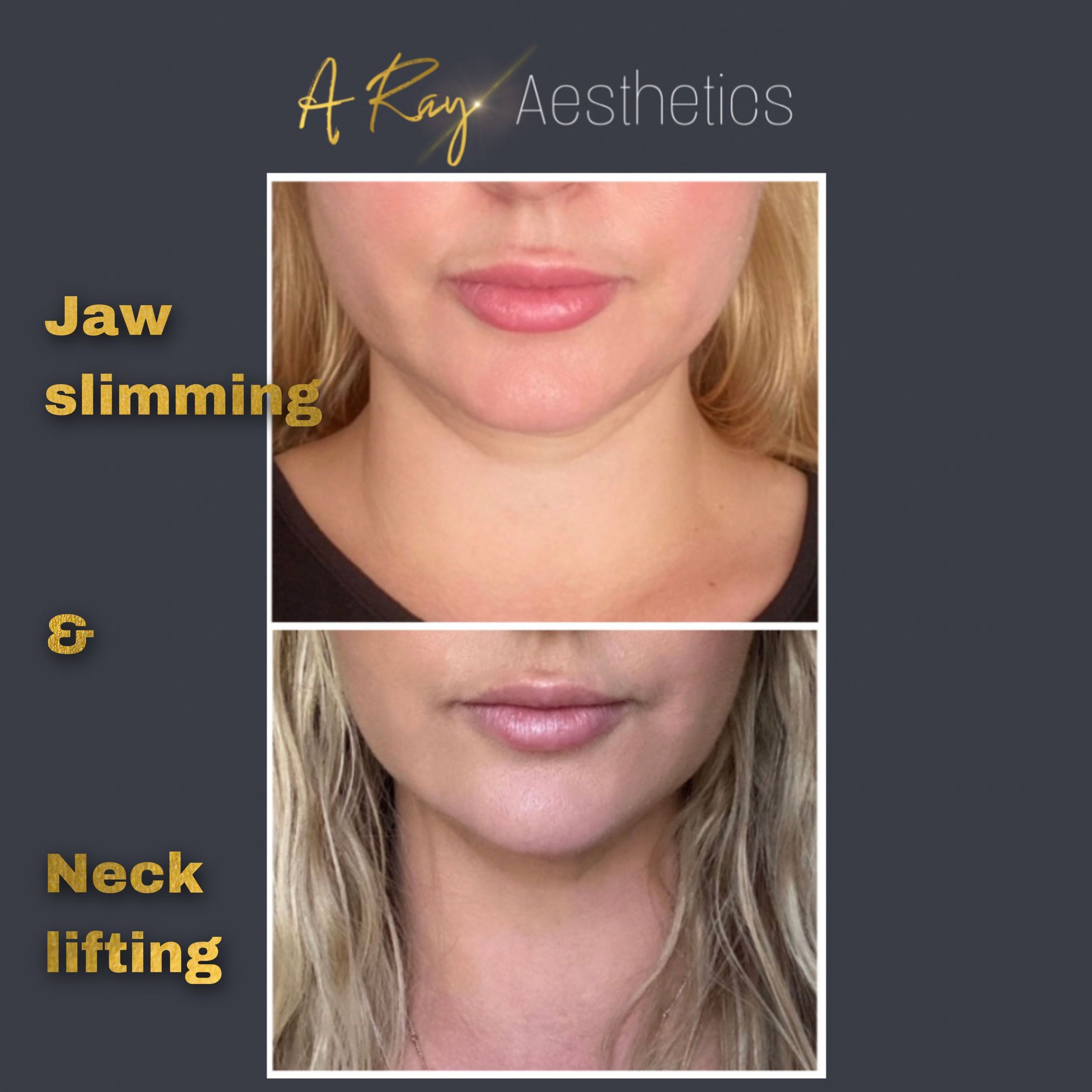 Jaw slimming & Neck lifting combined package portfolio