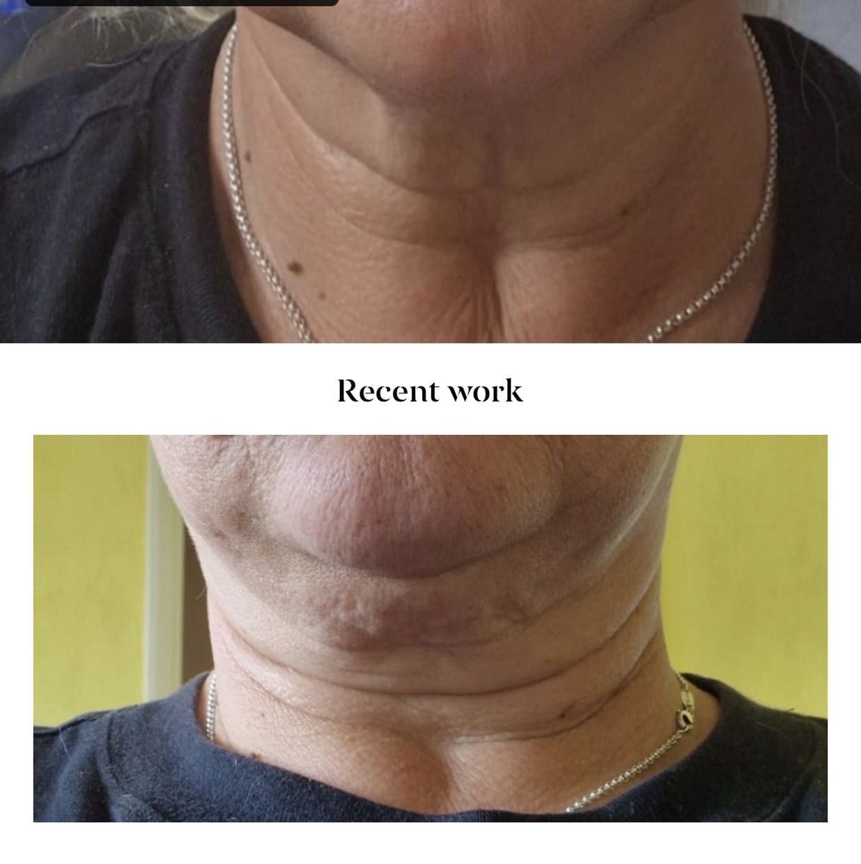 Neck tightening Treatment (turkey neck or rings ) portfolio