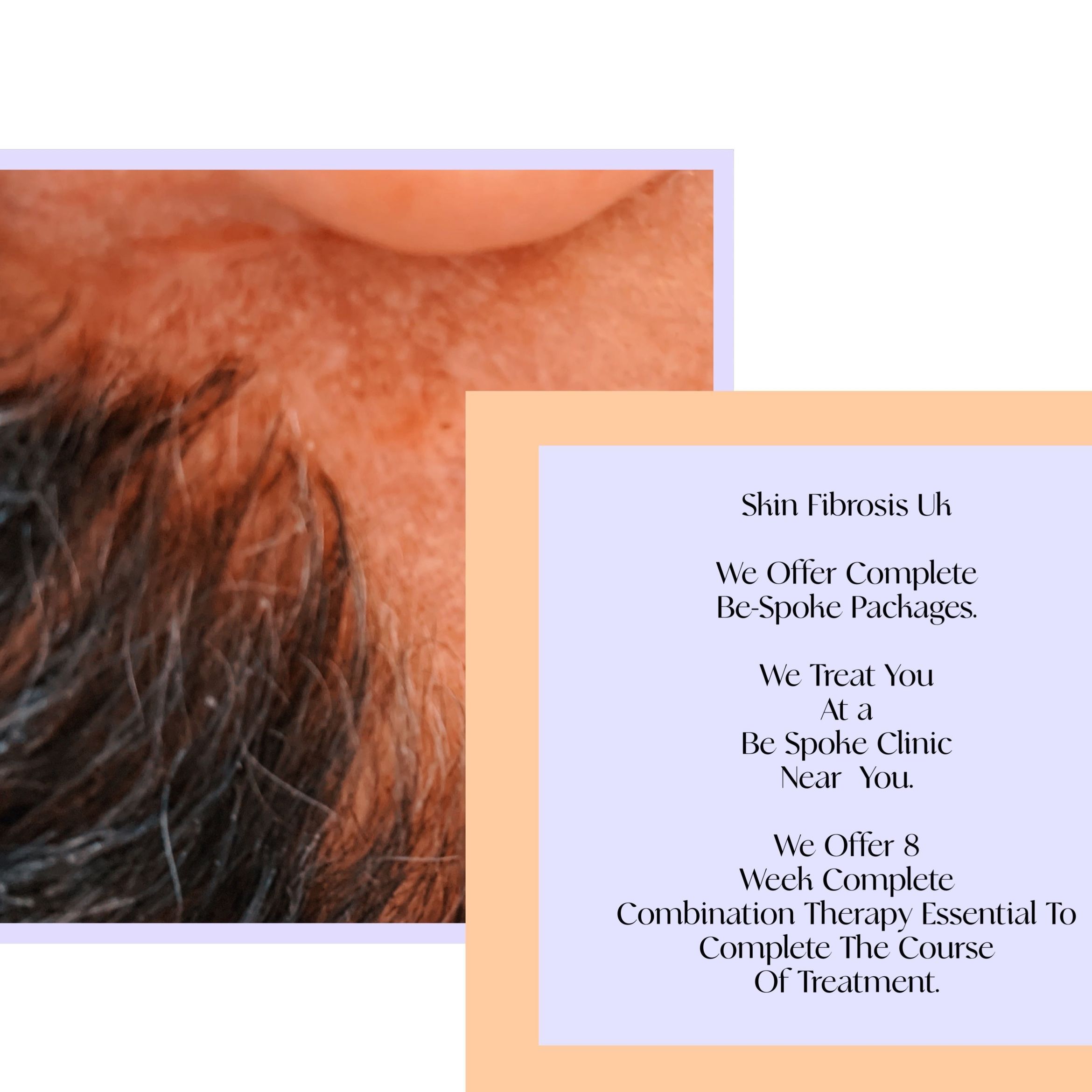 Skin Fibrosis uk - email: skinfibrosis@gmail.com portfolio