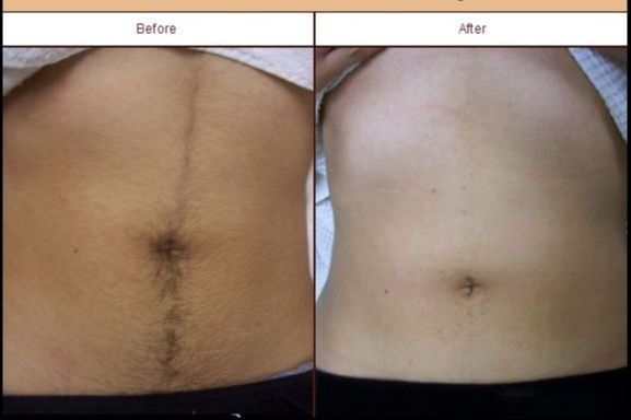 Laser Hair Removal For Woman portfolio