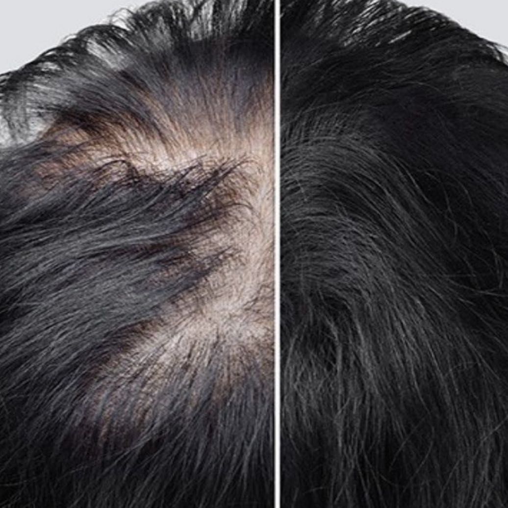 Hair Loss Injections - 5 sessions portfolio