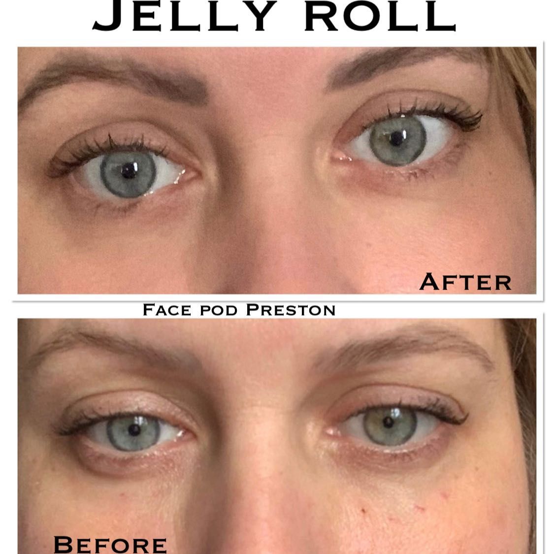 Jelly roll - under eye Botox portfolio