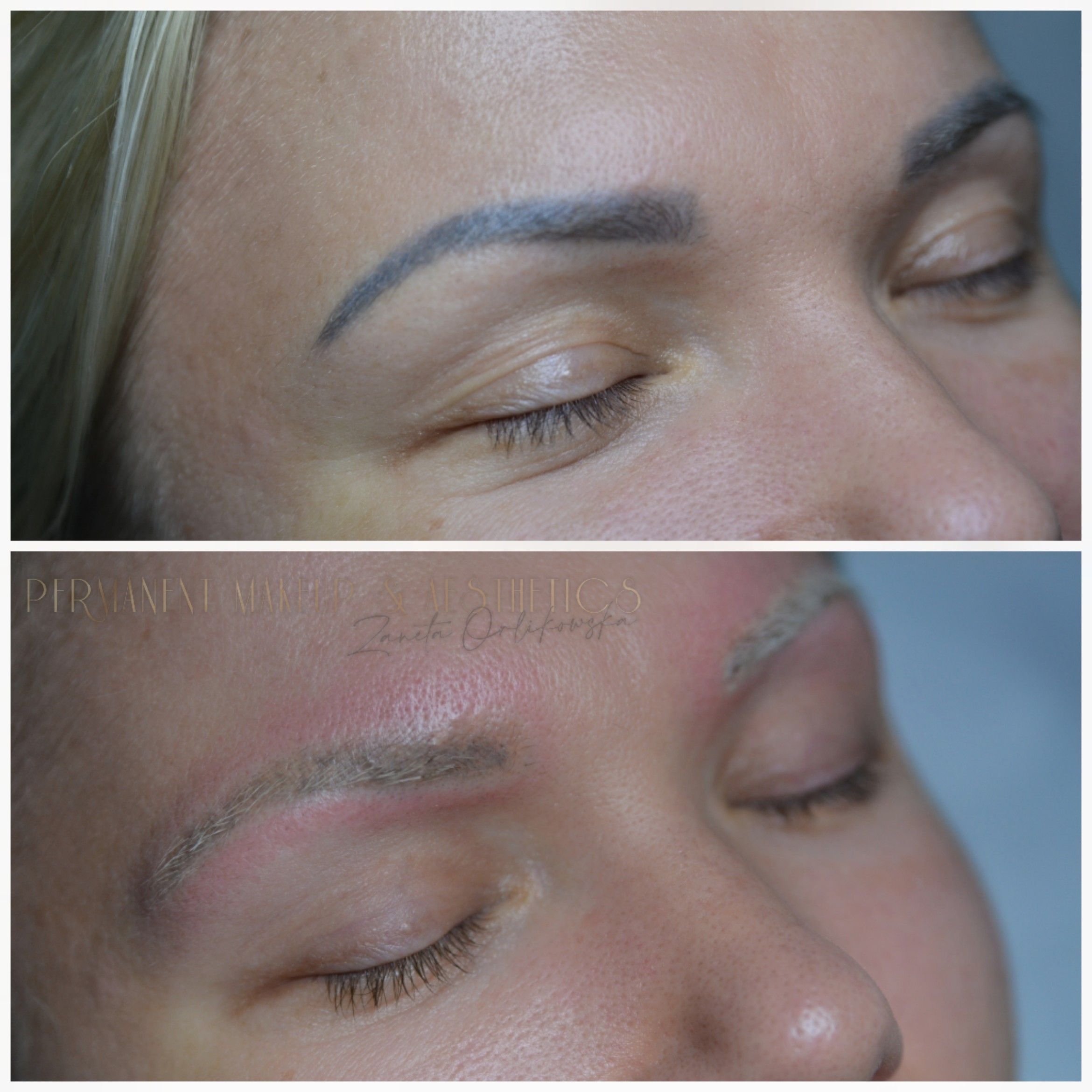 Eyebrows Laser Removal Per Session portfolio