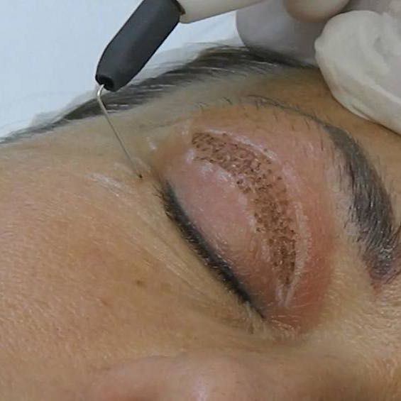 Plexr Non- surgical blepharoplasty top Eye Lift portfolio