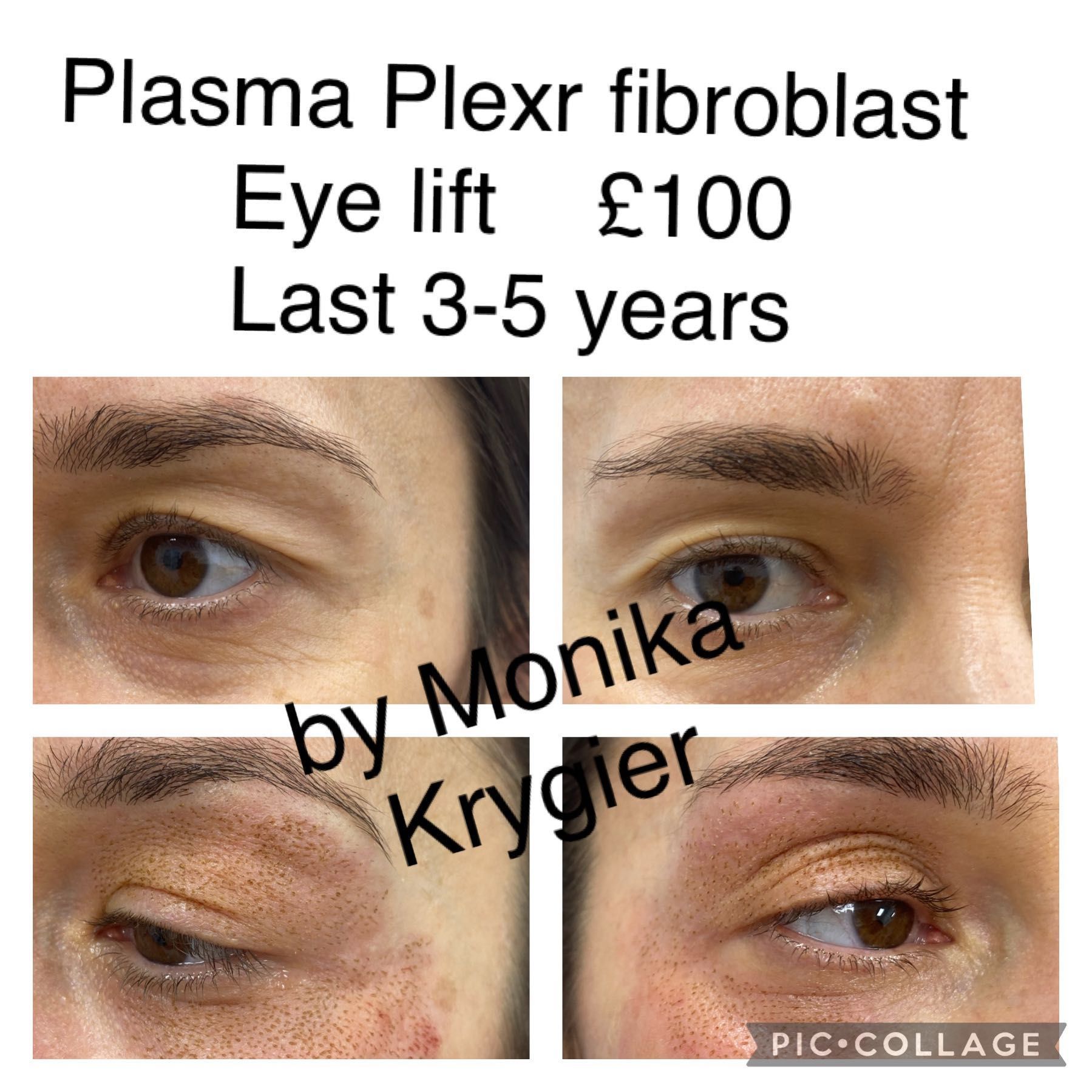 Plexr Fibroblast Lift Upper & Lower eyelids portfolio