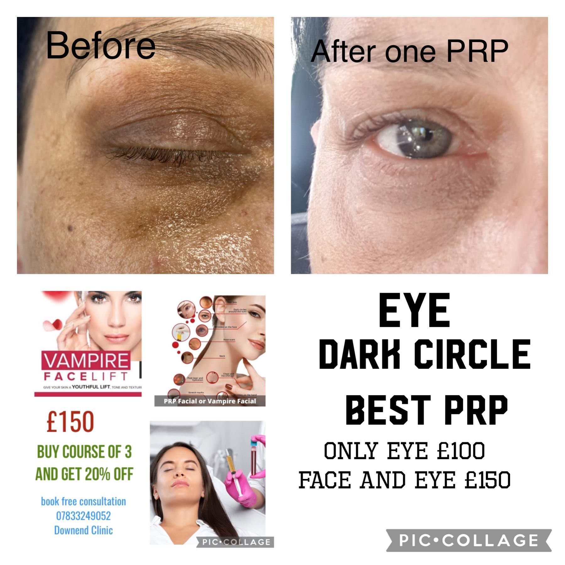 PRP Platelet Eye Dark circless/ puffiness portfolio