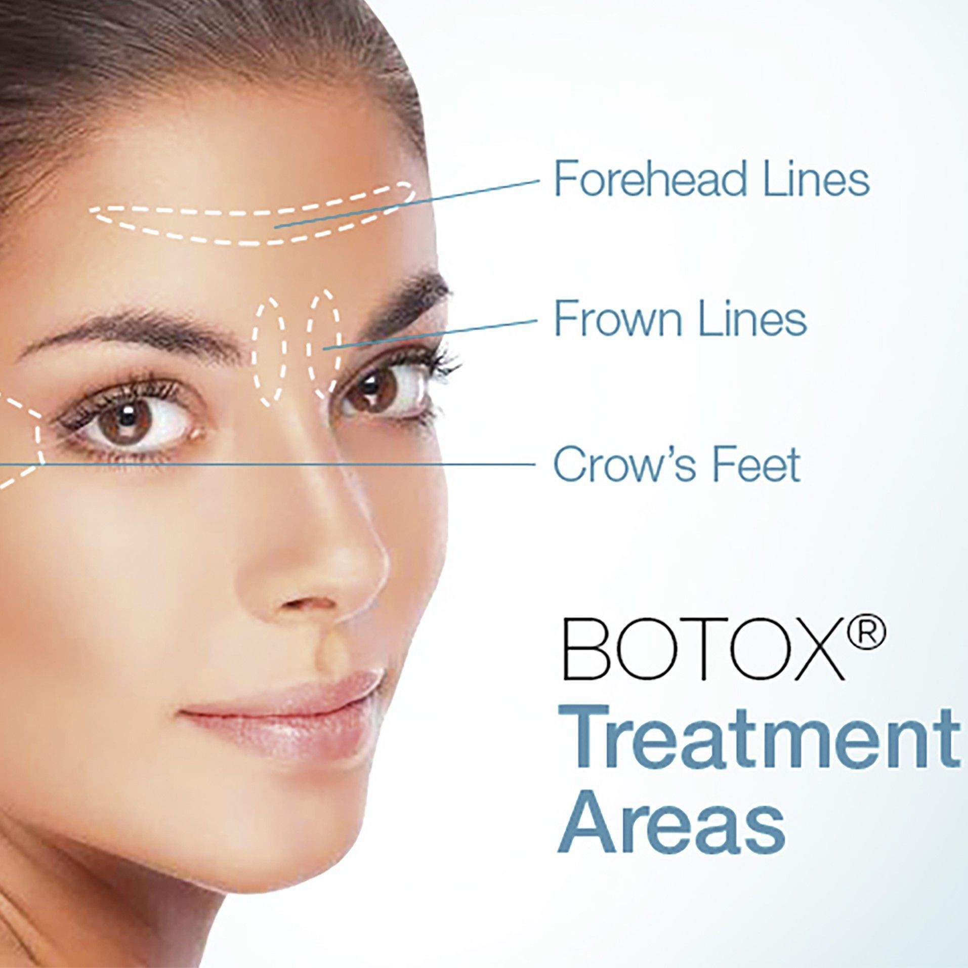 Botox For Facial Wrinkles portfolio