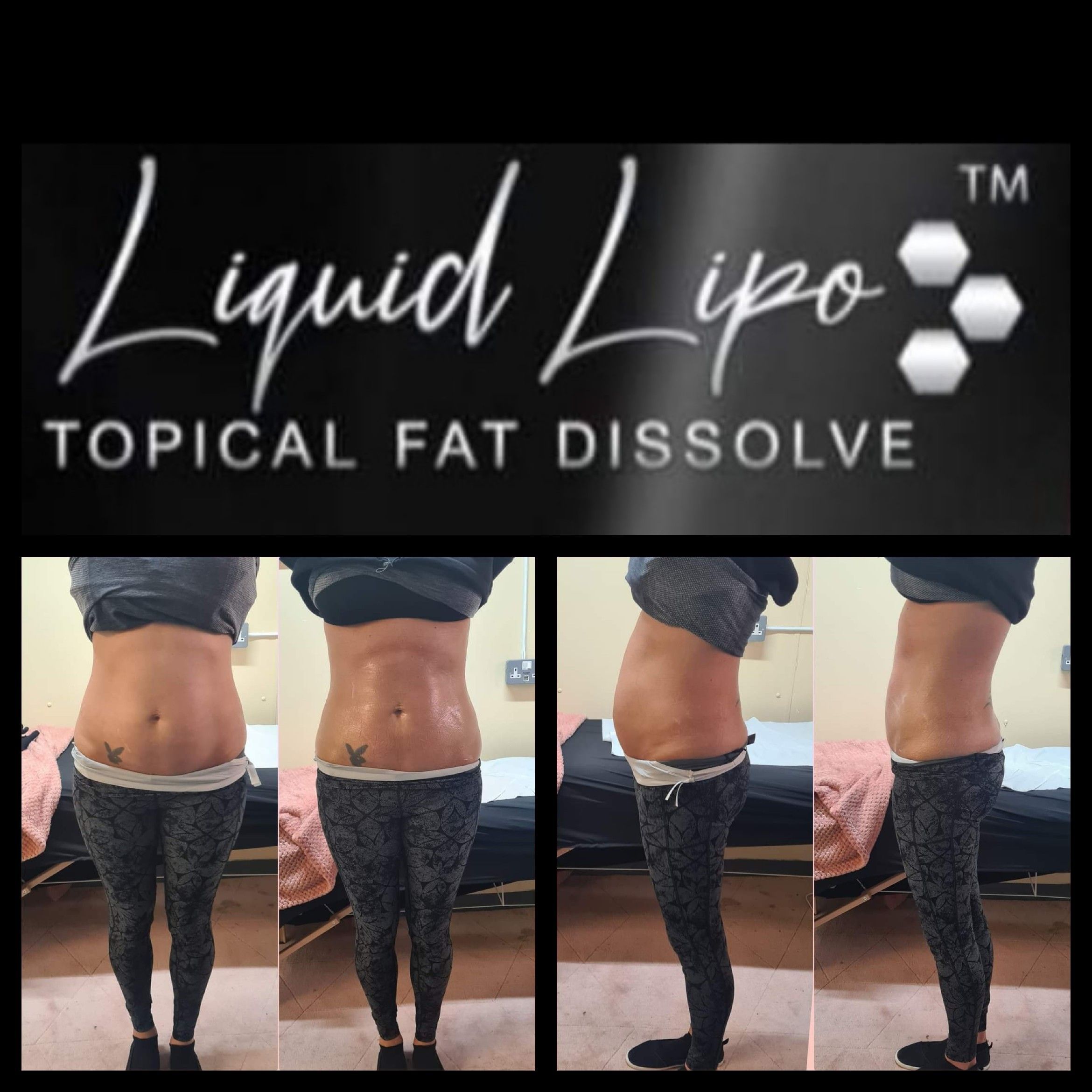 Liquid Lipo Fat Dissolving Treatments portfolio