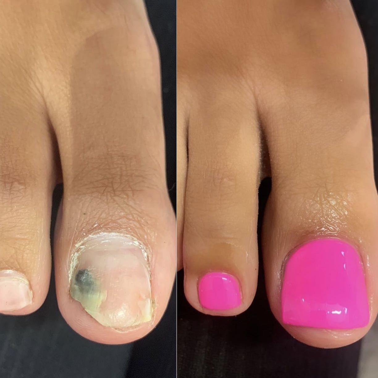Toe nail reconstruction with plain colour portfolio