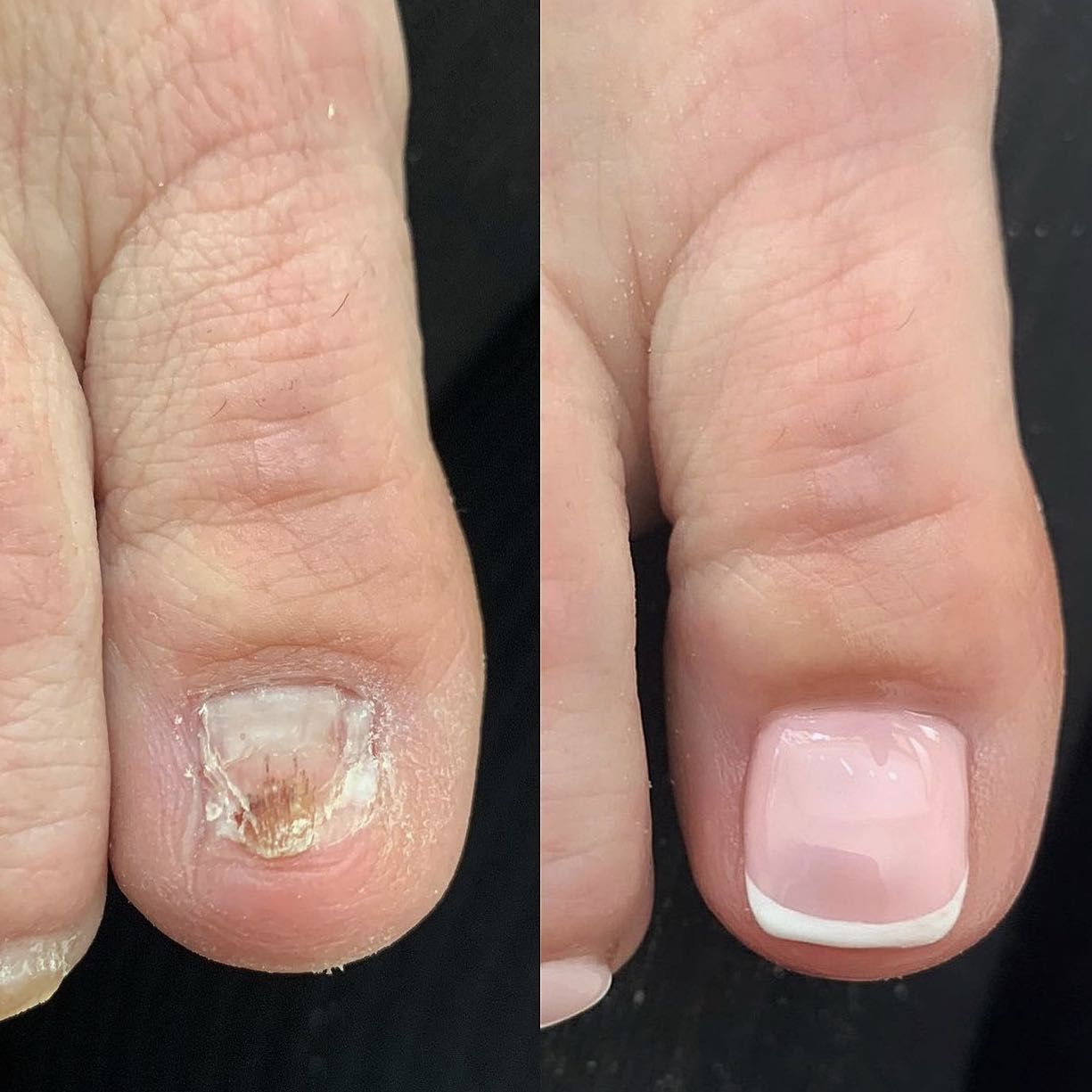 Toe nail reconstruction with French manicure portfolio