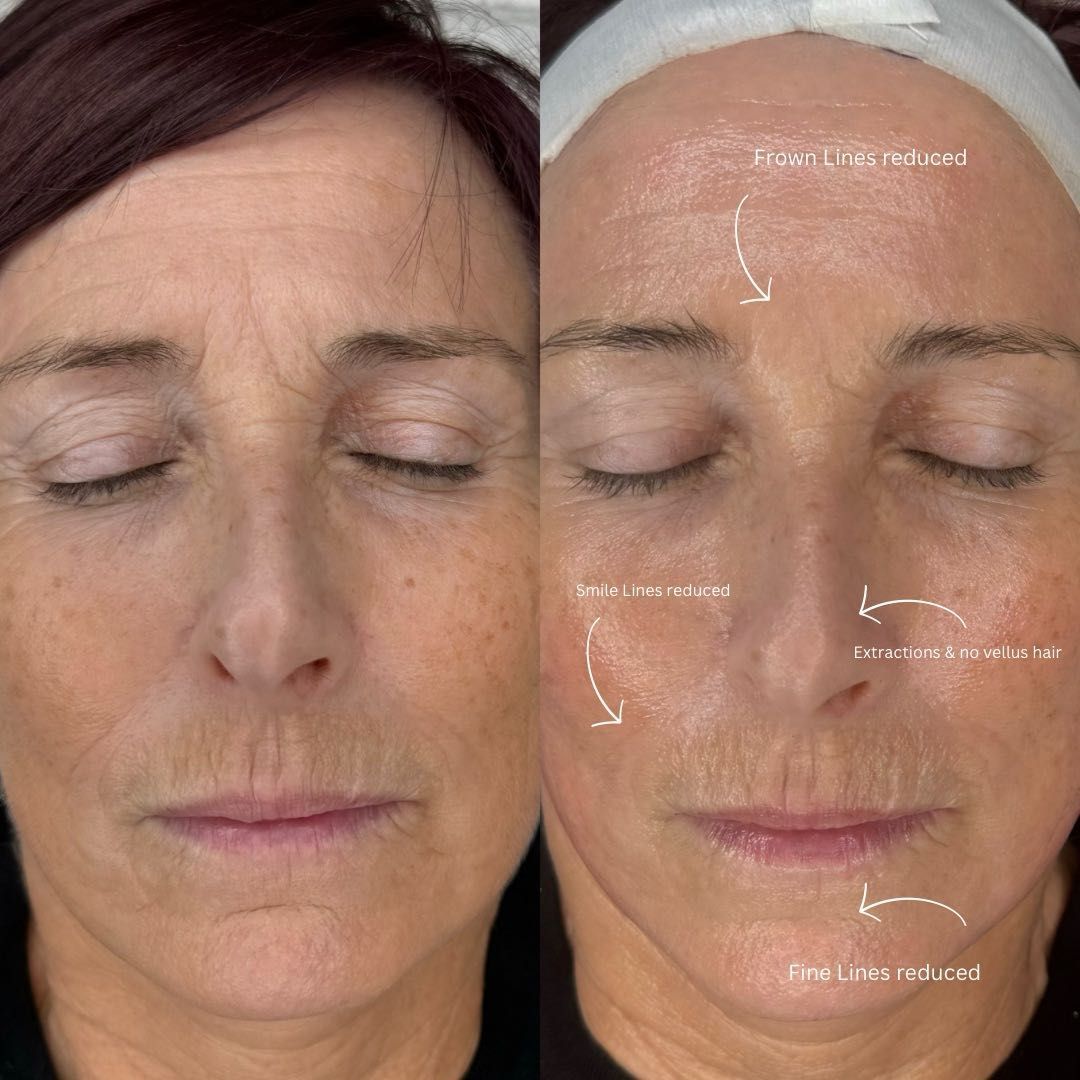 3 Sessions of ‘Botox Facial’ portfolio