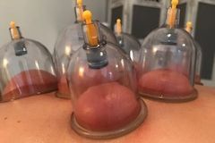 Dry Cupping Therapy portfolio