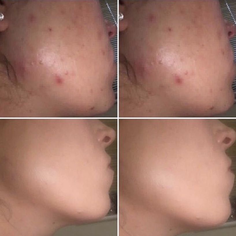 Chemical Peel to Treat Acne & Blemished Skin portfolio