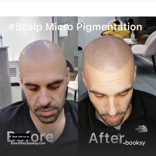Scalp micro pigmentation portfolio