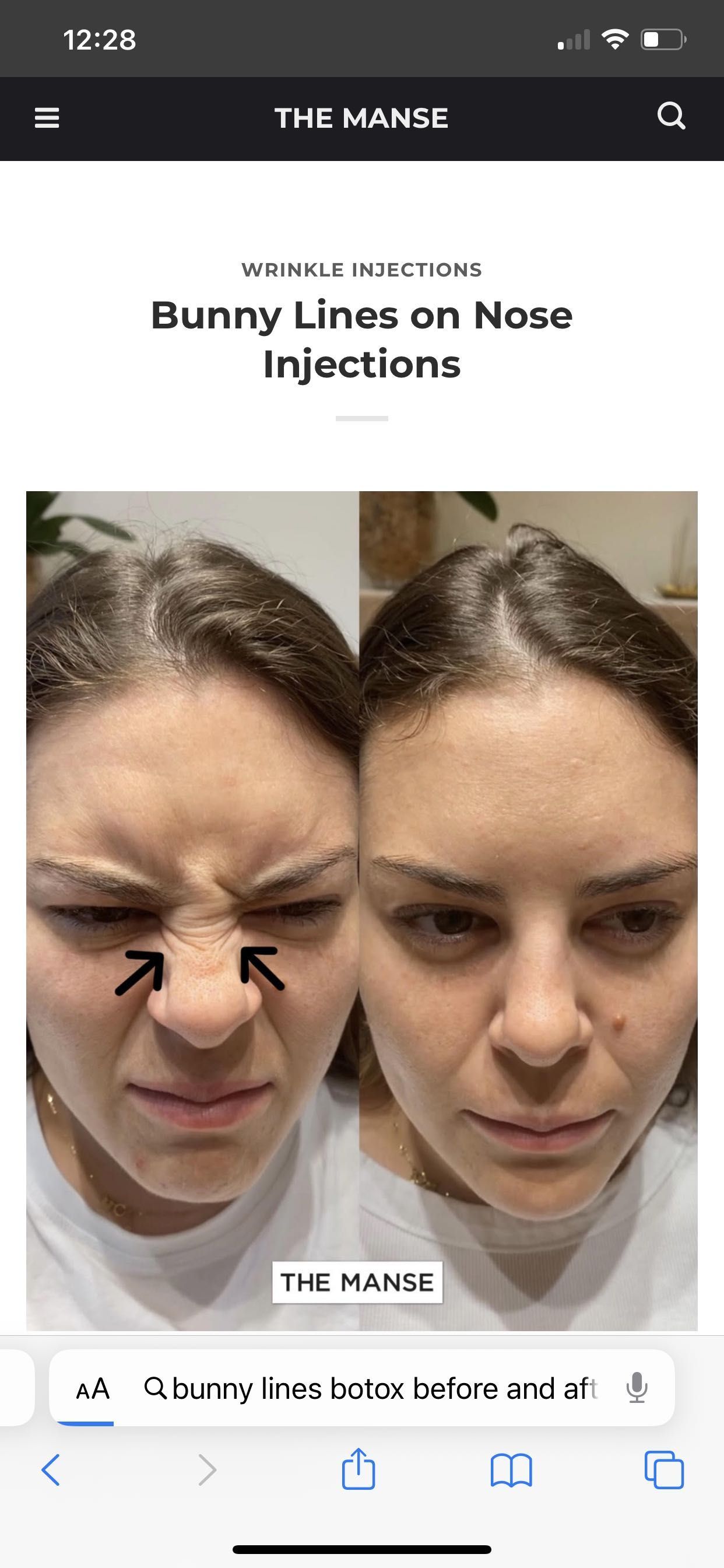 Bunny lines on nose anti wrinkle portfolio