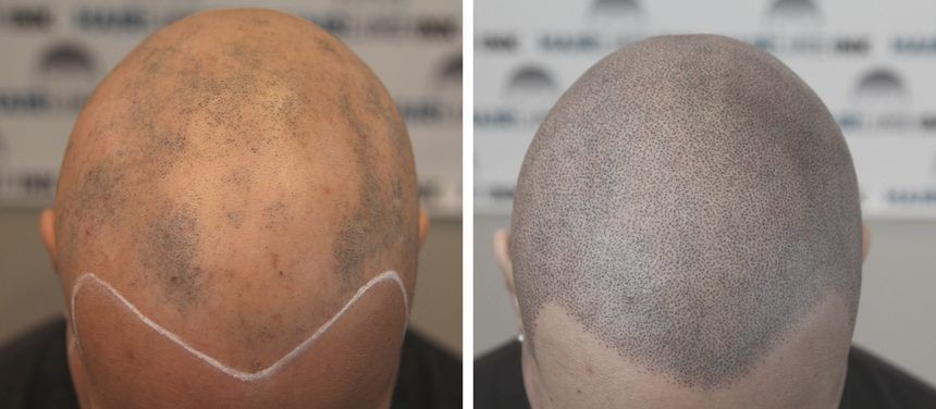 Portfolio usługi Pigmentacja skóry głowy - szczyt głowy