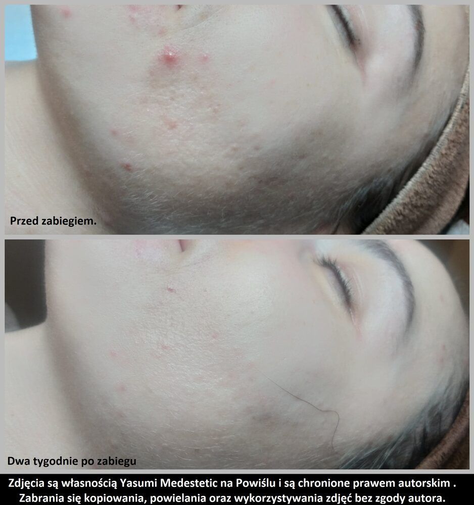 Portfolio usługi COMBO SKIN - mix kwasów - cel: retusz skóry twarzy