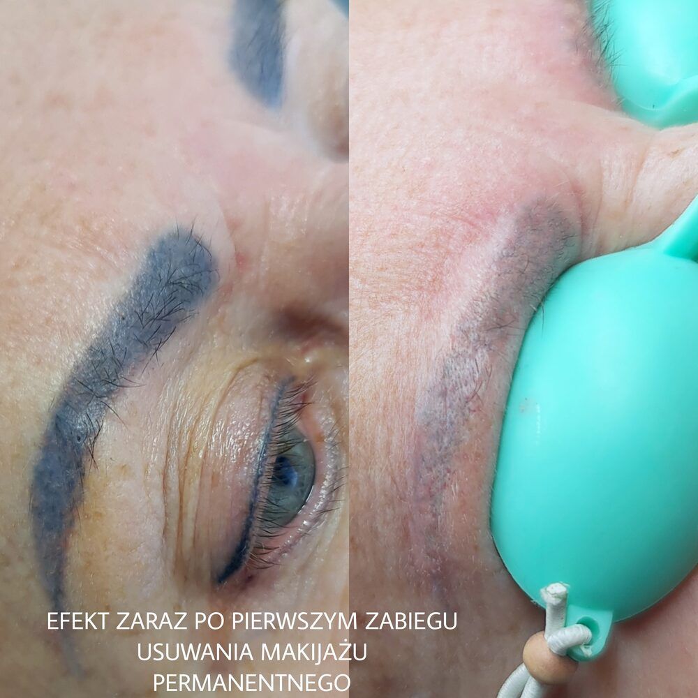 Portfolio usługi Laserowe usuwanie makijażu permanentnego (brwi,...