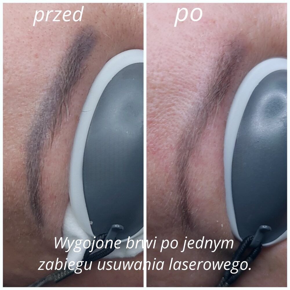 Portfolio usługi Laserowe usuwanie makijażu permanentnego (brwi,...