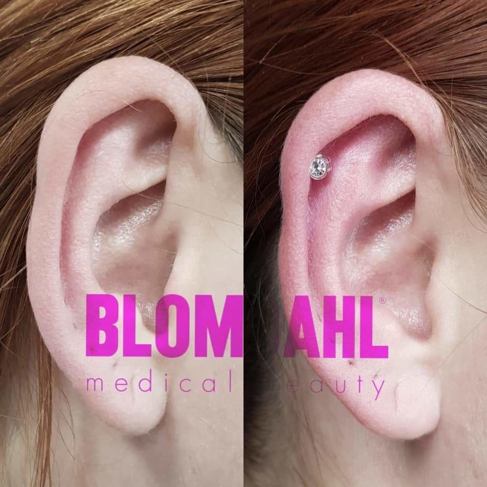Portfolio usługi BLOMDAHL - przekłucie chrząstki ucha