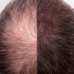 Portfolio usługi KARBOKSYTERAPIA - Pobudzenie cebulek włosa