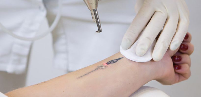 Portfolio usługi Laserowe usuwanie tatuażu (5x5cm)