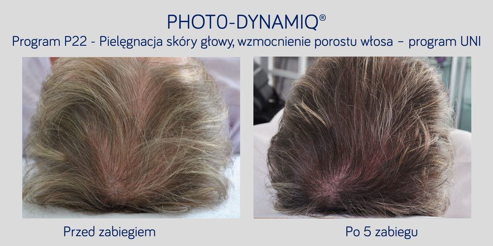 Portfolio usługi stymulacja porostu włosów.