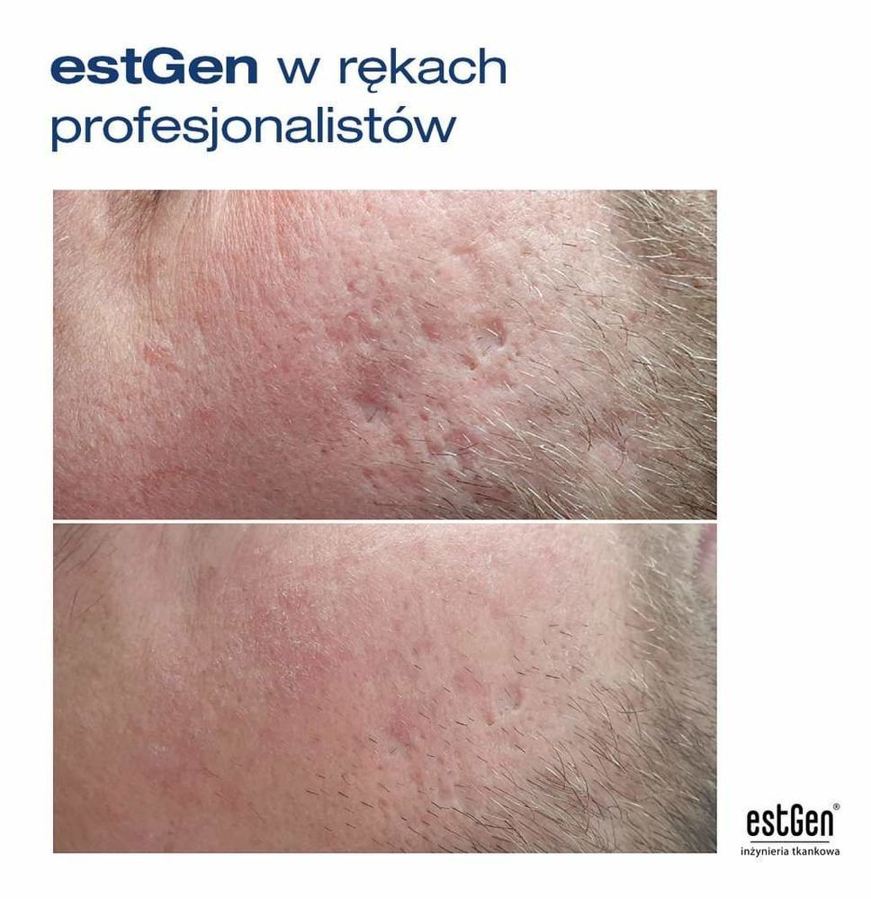 Portfolio usługi EstGen z mikronakłuwaniem skóry - inżynieria t...