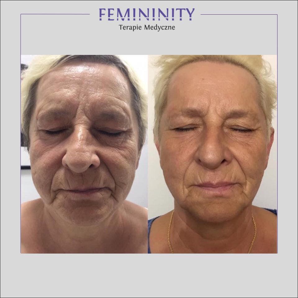 Portfolio usługi Termolifting skóry - owal twarzy + szyja - lift...