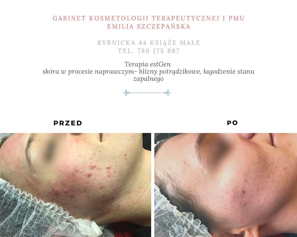Portfolio usługi estGen- terapia trądzik pospolity/ acne tarda i...