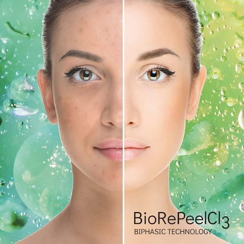 Portfolio usługi TCA 35% BioRePeel twarz/szyja