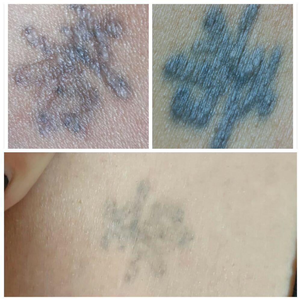 Portfolio usługi Laserowe usuwanie tatuażu i makijażu permanentn...