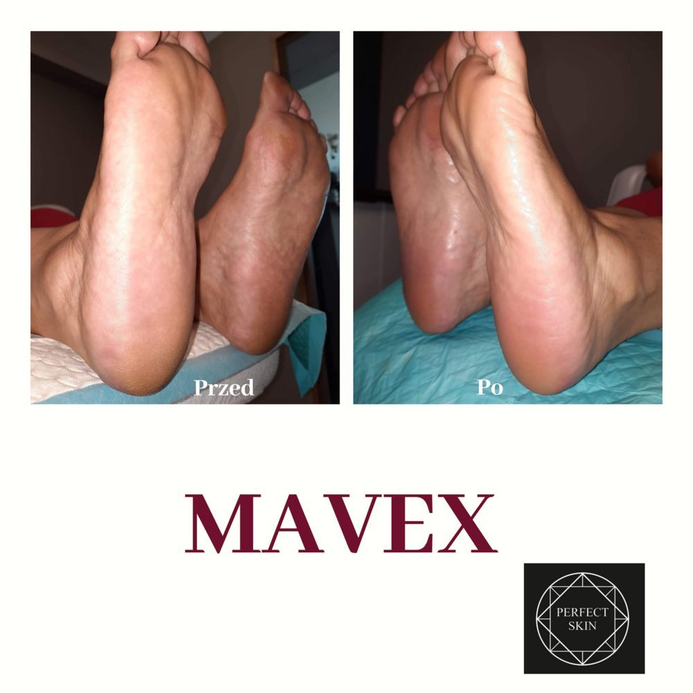 Portfolio usługi Pedicure kwasowy Mavex- usuwanie martwego naskórka