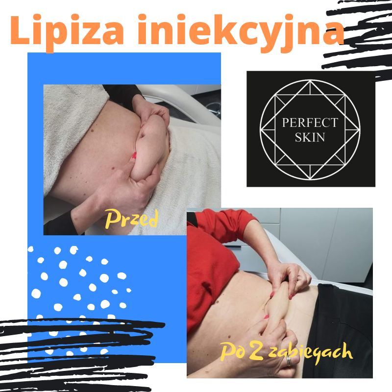Portfolio usługi Lipoliza iniekcyjna + 10ml