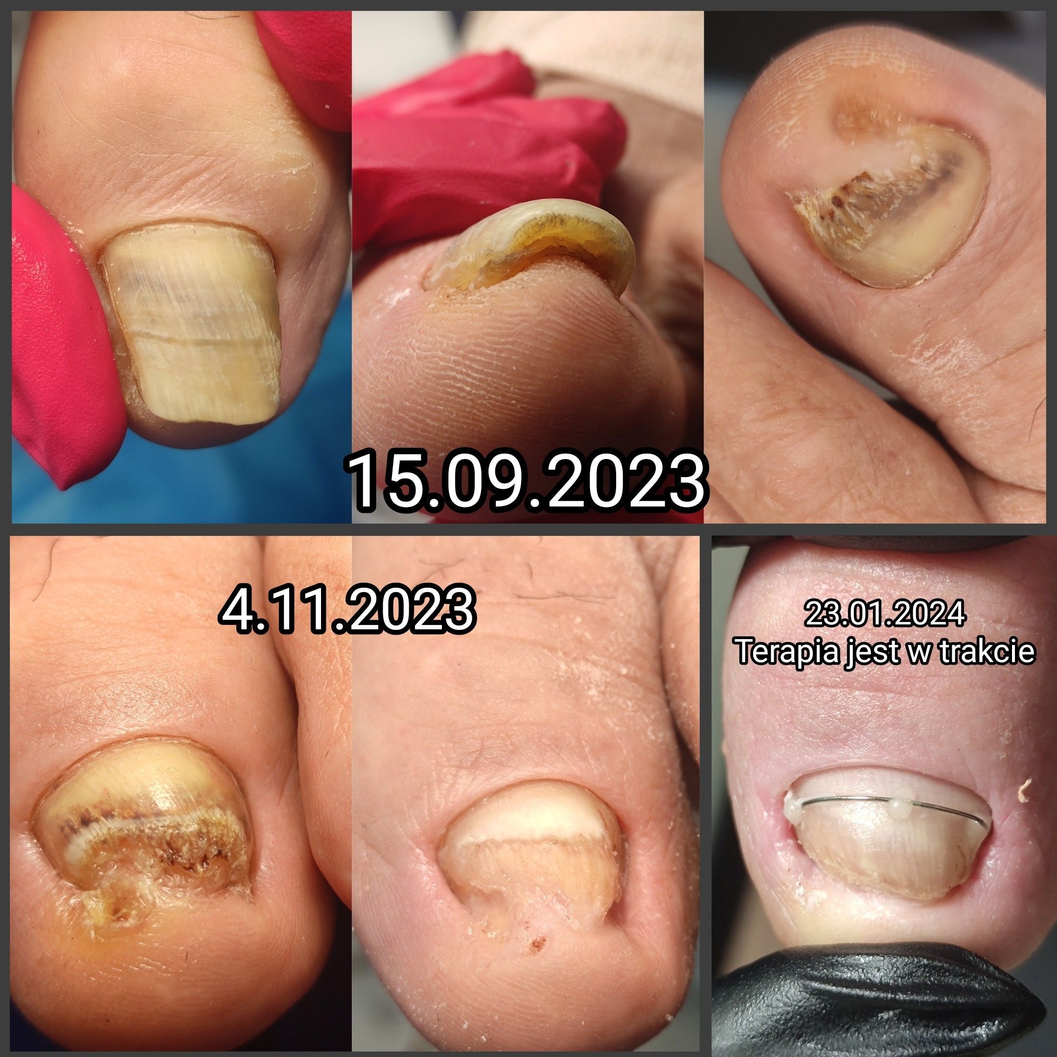 Portfolio usługi Opracowanie paznokci zmienionych chorobowo