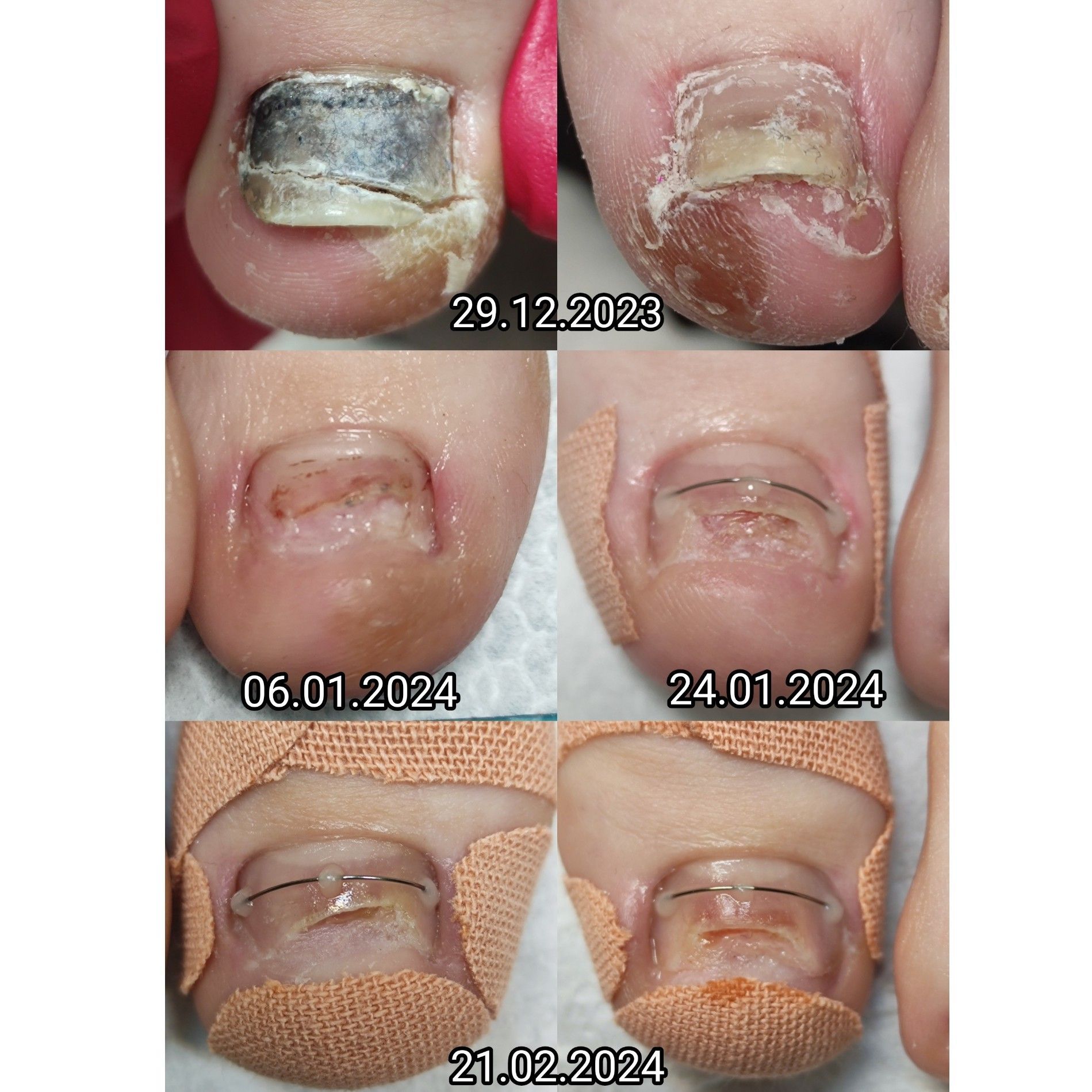 Portfolio usługi Oczyszczenie paznokcia