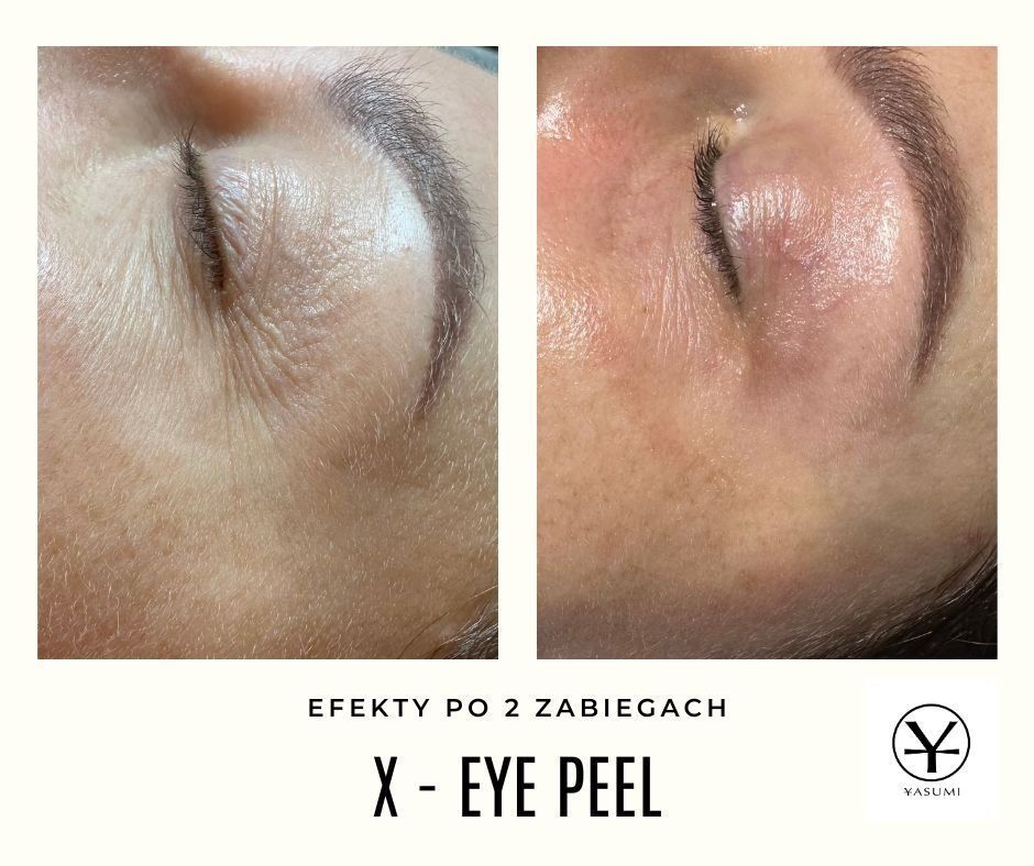 Portfolio usługi NOWOŚĆ : X - Eye Peel - Peptydowo-kwasowa terapia