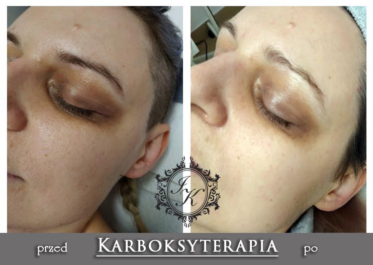 Portfolio usługi Karboksyterapia oczy (cienie i zmarszczki pod o...
