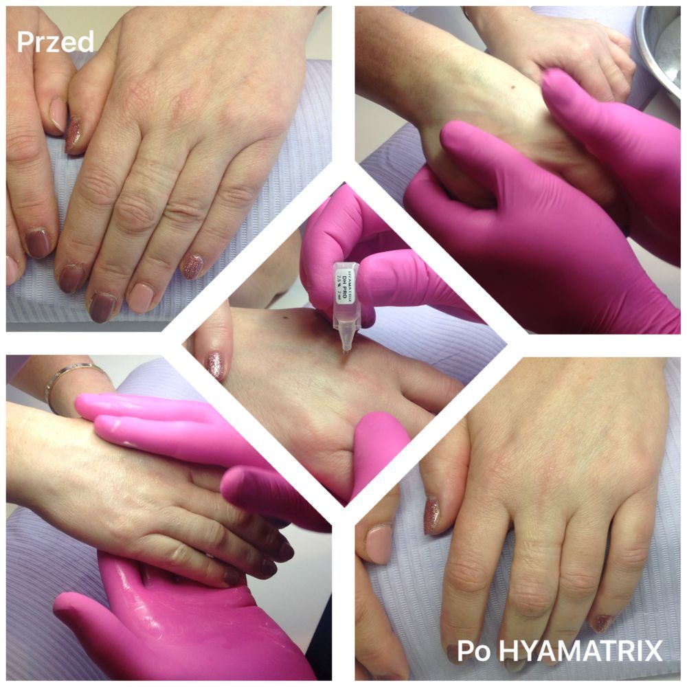 Portfolio usługi Biorewitalizacja dłoni HYAMATRIX