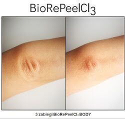 Portfolio usługi BioRePeel na ciało